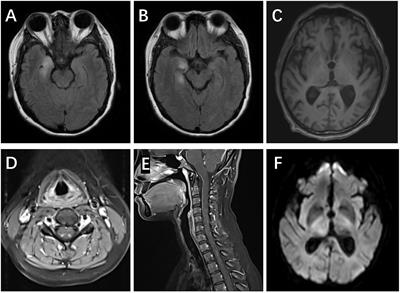 Anti-amphiphysin encephalitis: Expanding the clinical spectrum